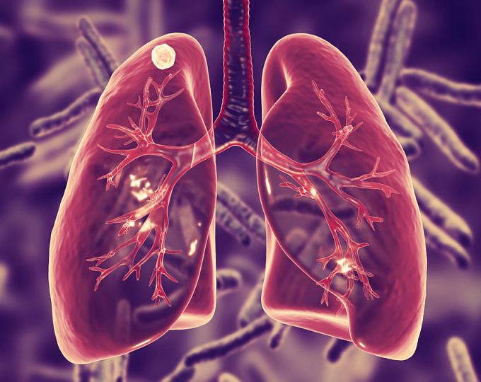 24 марта - Всемирный день борьбы с туберкулезом